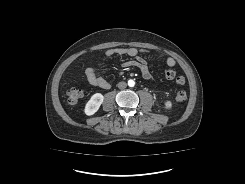 Brain metastases from renal cell carcinoma (Radiopaedia 42222-45328 A 154).jpg
