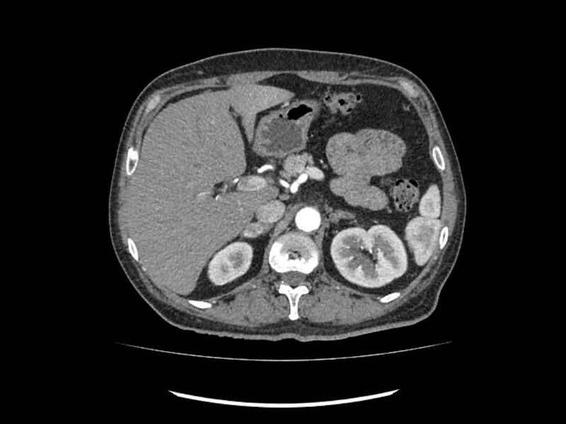 File:Brain metastases from renal cell carcinoma (Radiopaedia 42222-45328 A 38).jpg