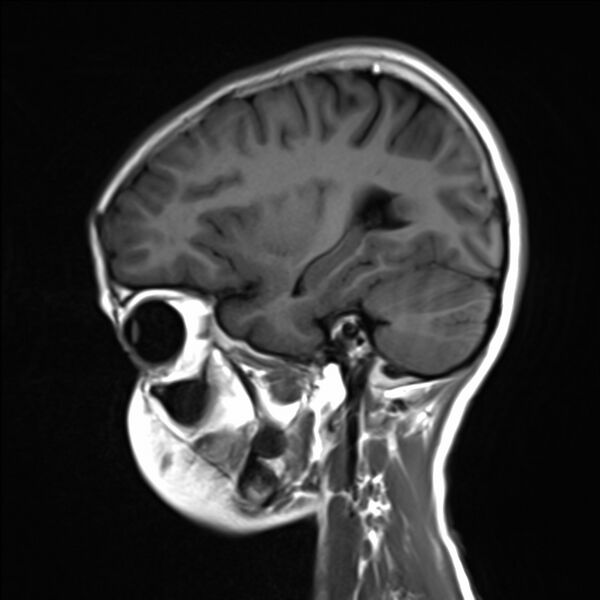 File:Brainstem glioma (Radiopaedia 70548-80674 Sagittal T1 18).jpg