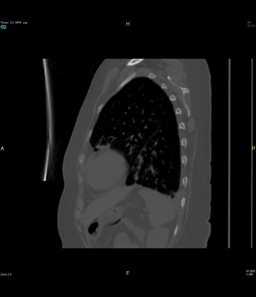 Breast primary with lung and bone metastases (Radiopaedia 40620-43228 Sagittal bone window 69).jpg