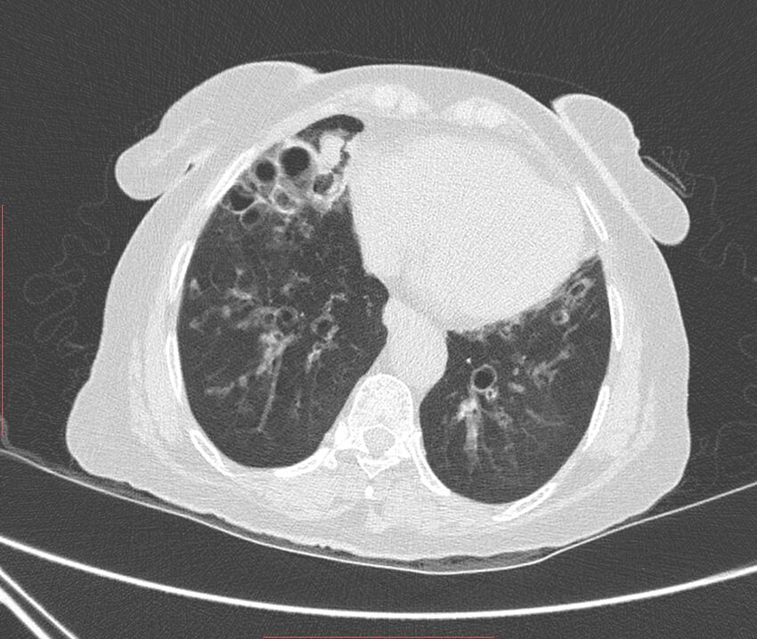 Bronchiectasis (Radiopaedia 72693-83293 Axial lung window 98).jpg