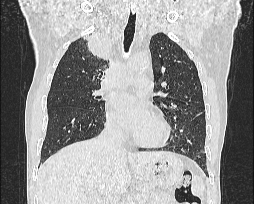 Bronchogenic carcinoma with superior vena cava syndrome (Radiopaedia 36497-38054 Coronal lung window 26).jpg