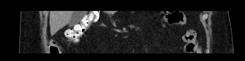 File:Buried bumper syndrome - gastrostomy tube (Radiopaedia 63843-72575 Coronal Inject 35).jpg