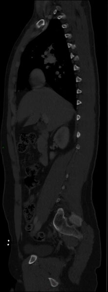 File:Burst fracture (Radiopaedia 83168-97542 Sagittal bone window 55).jpg