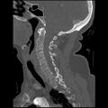 C1 anterior arch (plough) fracture - type 1 (Radiopaedia 76181-87720 Sagittal bone window 62).jpg