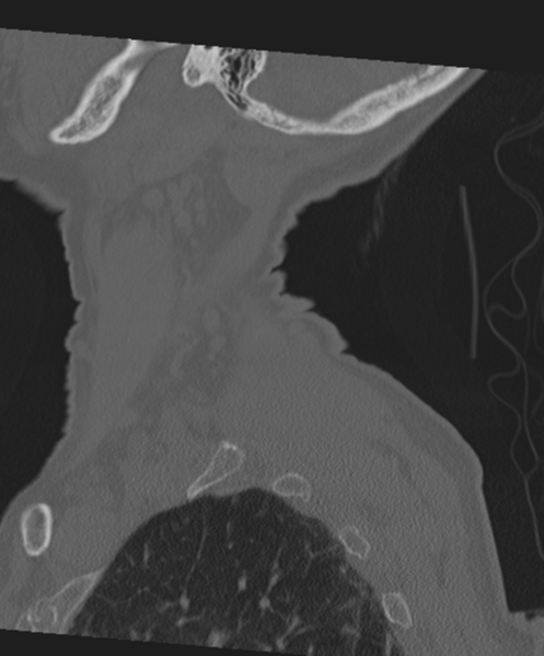 File:C2 fracture with vertebral artery dissection (Radiopaedia 37378-39199 Sagittal bone window 11).png