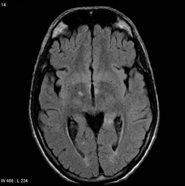 File:CMV ventriculitis and encephalitis (Radiopaedia 5416-7166 Axial FLAIR 3).jpg