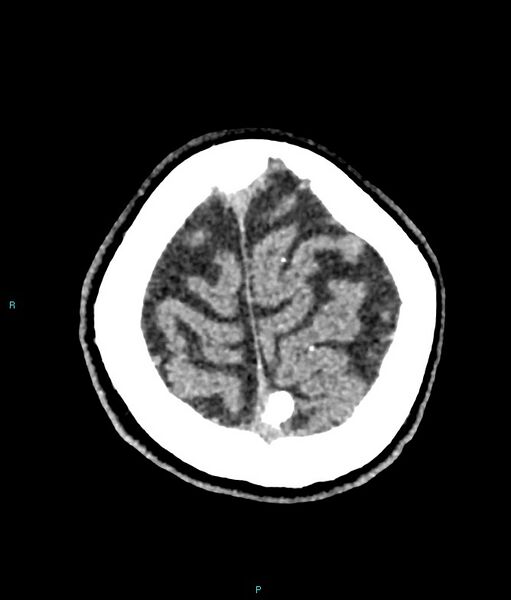File:Calcified cerebral emboli from left ventricular thrombus (Radiopaedia 84420-99758 Axial non-contrast 14).jpg