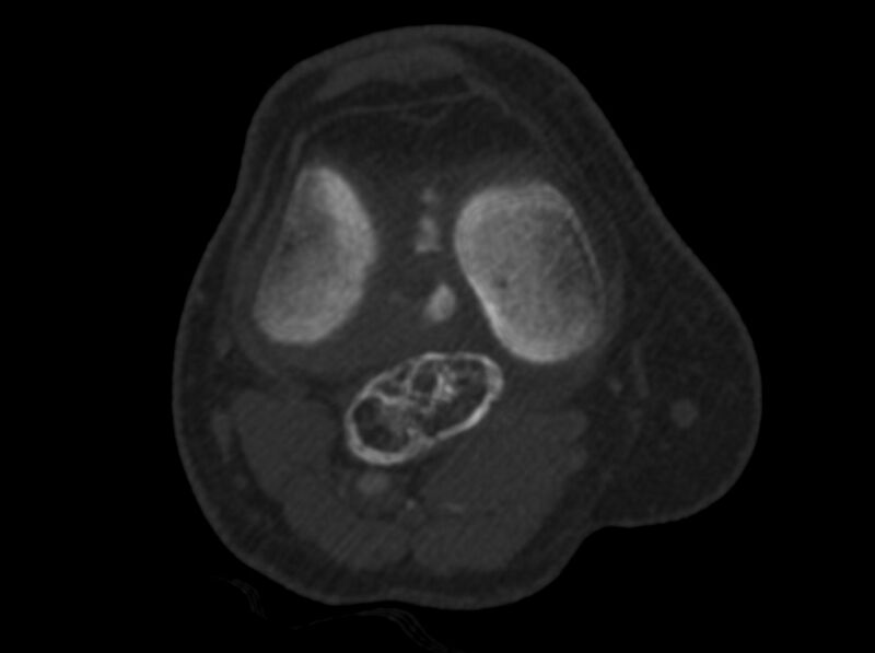 File:Calcified hematoma - popliteal fossa (Radiopaedia 63938-72763 C 18).jpg