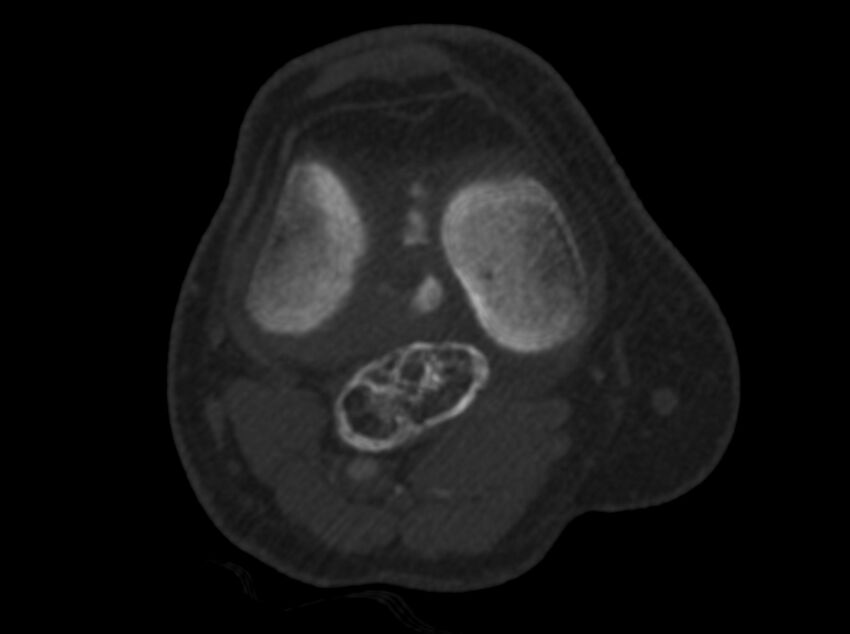 Calcified hematoma - popliteal fossa (Radiopaedia 63938-72763 C 18).jpg