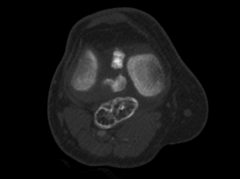 File:Calcified hematoma - popliteal fossa (Radiopaedia 63938-72763 C 20).jpg