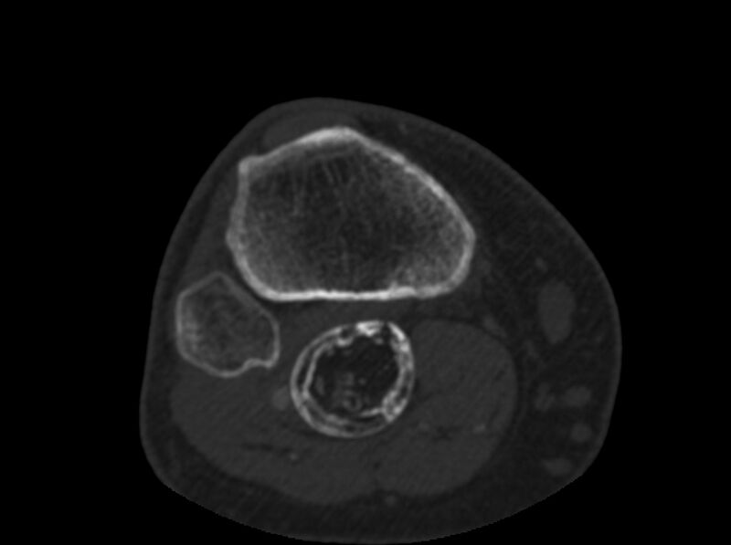 File:Calcified hematoma - popliteal fossa (Radiopaedia 63938-72763 C 69).jpg