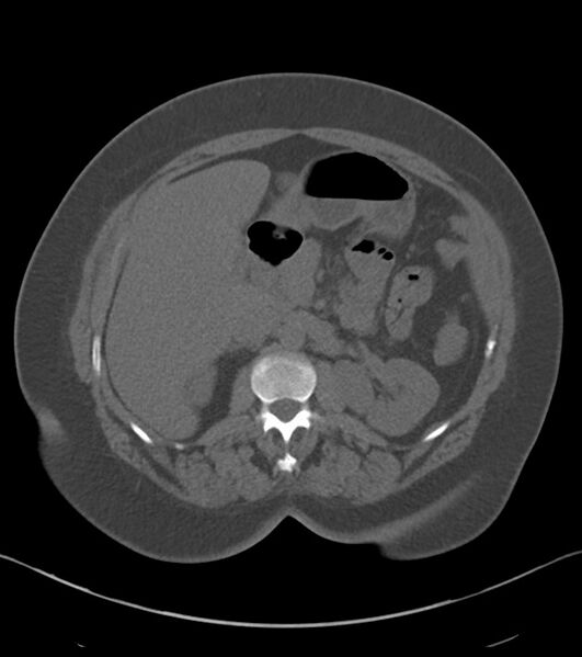 File:Calcified hepatic hydatid cyst (Radiopaedia 81127-94738 Axial non-contrast 35).jpg