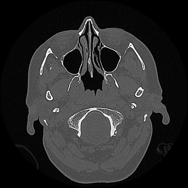 File:Canal up mastoidectomy (Radiopaedia 78108-90638 Axial bone window 10).jpg