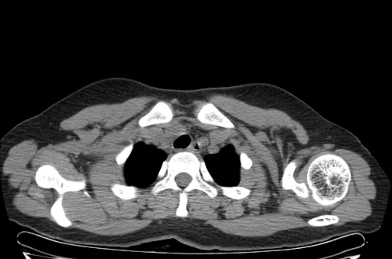 File:Cannonball metastases - uterine choriocarcinoma (Radiopaedia 70137-80173 Axial non-contrast 3).jpg