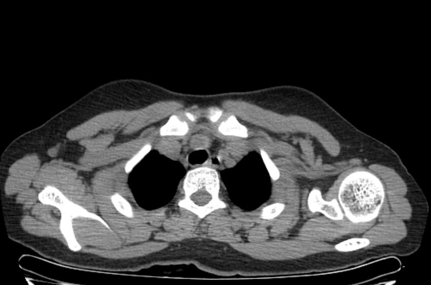 Cannonball metastases - uterine choriocarcinoma (Radiopaedia 70137-80173 Axial non-contrast 6).jpg