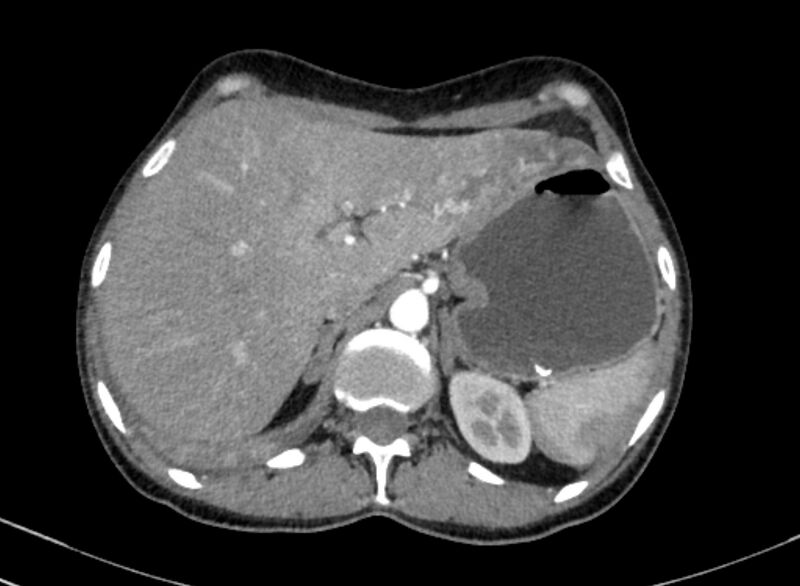 File:Cannonball metastases from breast cancer (Radiopaedia 91024-108569 A 116).jpg