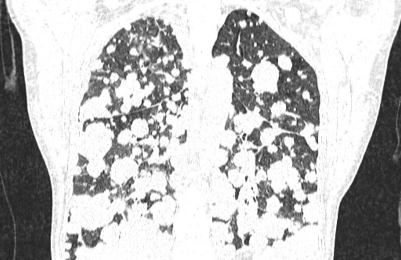 File:Cannonball metastases from breast cancer (Radiopaedia 91024-108569 Coronal lung window 99).jpg