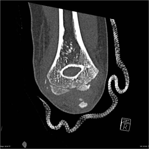 File:Capitellum fracture (Radiopaedia 23352-23426 Coronal bone window 18).jpg