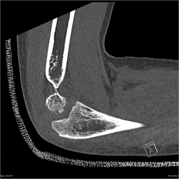 File:Capitellum fracture (Radiopaedia 23352-23426 Sagittal bone window 29).jpg
