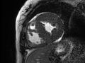 Cardiac amyloidosis (Radiopaedia 61600-69579 Short axis bSSFP 138).jpg
