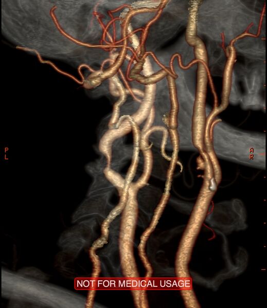 File:Carotid artery stenosis (Radiopaedia 28786-29086 A 10).jpg
