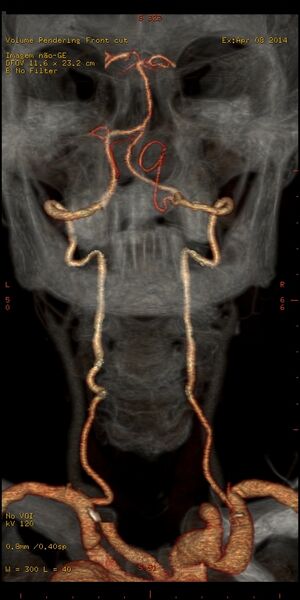 File:Carotid artery stenosis (Radiopaedia 28786-29086 B 8).jpg