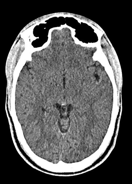 File:Cavum septum pellucidum and cavum vergae (Radiopaedia 77797-90060 Axial Brain Window 47).jpg