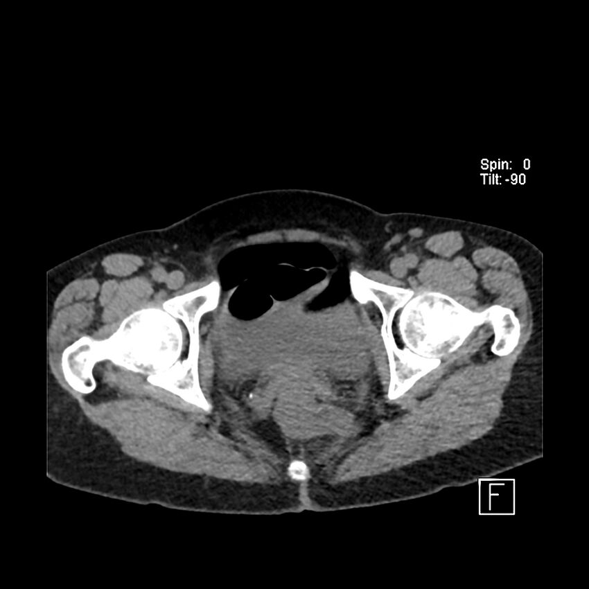 Cecal volvulus (Radiopaedia 90897-108397 Axial non-contrast 66).jpg