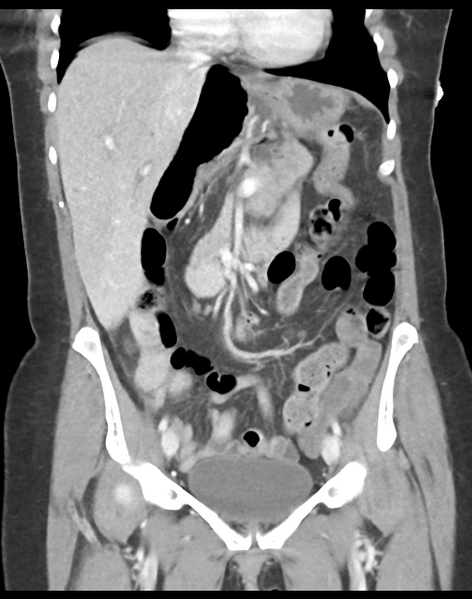 File:Cecum hernia through the foramen of Winslow (Radiopaedia 46634-51112 B 21).png