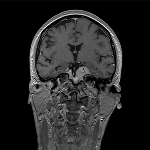 File:Central base of skull meningioma (Radiopaedia 53531-59549 Coronal T1 C+ 19).jpg