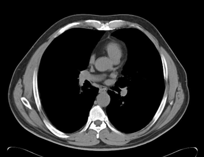 File:Centrilobular pulmonary emphysema (Radiopaedia 26808-26971 Axial non-contrast 23).jpg