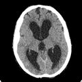 Cerebellar abscess secondary to mastoiditis (Radiopaedia 26284-26412 Axial non-contrast 78).jpg