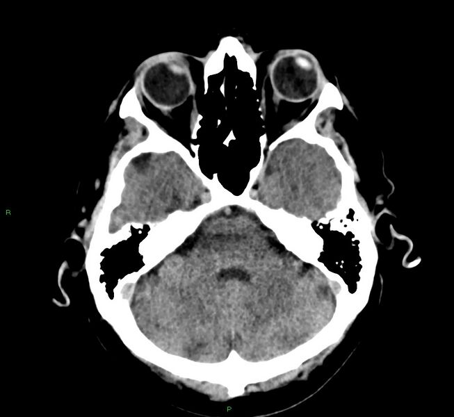 File:Cerebral amyloid angiopathy-associated lobar intracerebral hemorrhage (Radiopaedia 58376-65511 Axial non-contrast 42).jpg