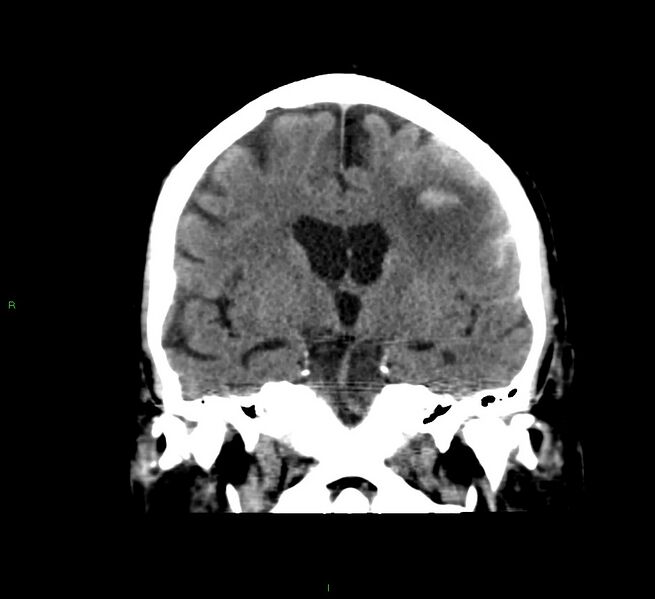 File:Cerebral amyloid angiopathy-associated lobar intracerebral hemorrhage (Radiopaedia 58376-65511 Coronal non-contrast 36).jpg
