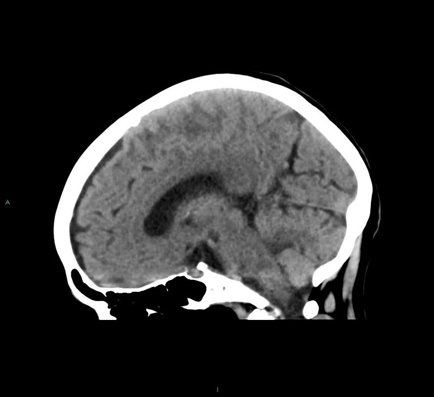 Cerebral amyloid angiopathy-associated lobar intracerebral hemorrhage (Radiopaedia 58563-65727 C 30).jpg