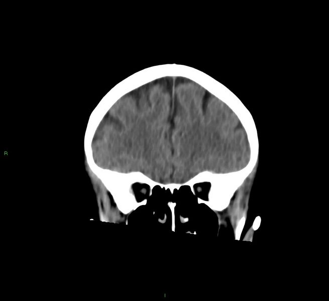 File:Cerebral amyloid angiopathy-associated lobar intracerebral hemorrhage (Radiopaedia 58757-65978 Coronal non-contrast 50).jpg