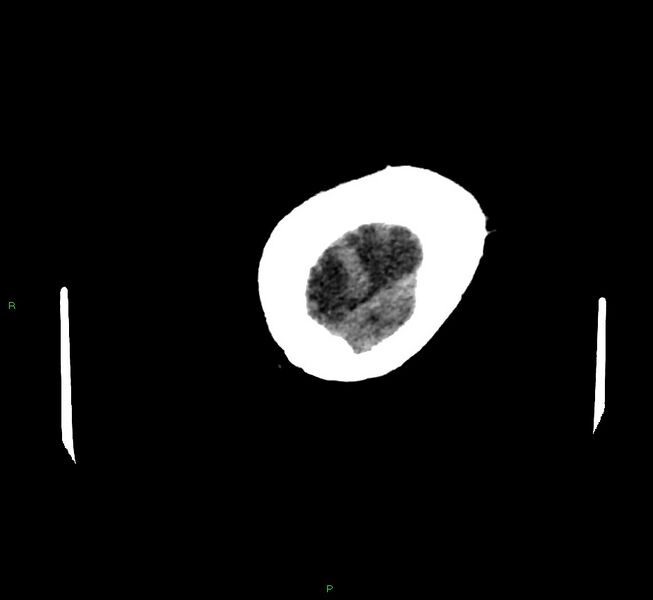 File:Cerebral amyloid angiopathy-associated lobar intracerebral hemorrhage (Radiopaedia 58757-65979 Axial non-contrast 137).jpg