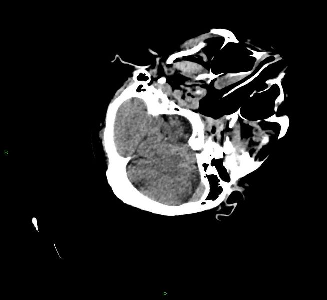 File:Cerebral amyloid angiopathy-associated lobar intracerebral hemorrhage (Radiopaedia 58757-65979 Axial non-contrast 32).jpg