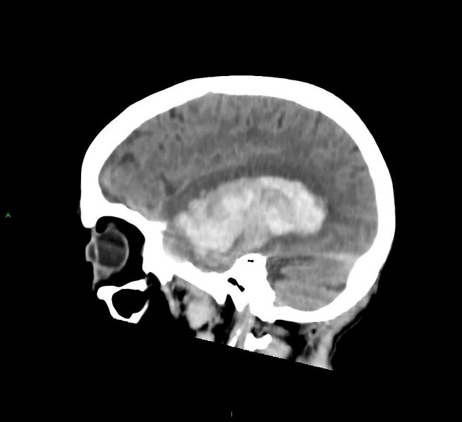 File:Cerebral amyloid angiopathy-associated lobar intracerebral hemorrhage (Radiopaedia 58758-65980 C 16).jpg