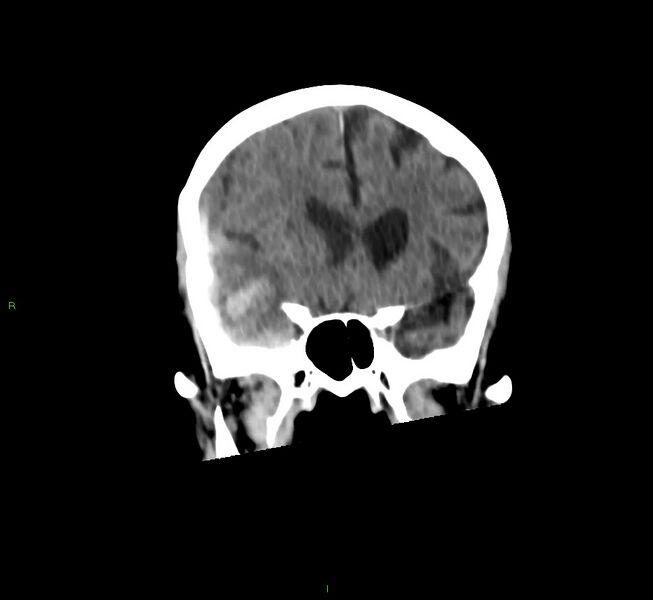 File:Cerebral amyloid angiopathy-associated lobar intracerebral hemorrhage (Radiopaedia 58758-65980 Coronal non-contrast 43).jpg