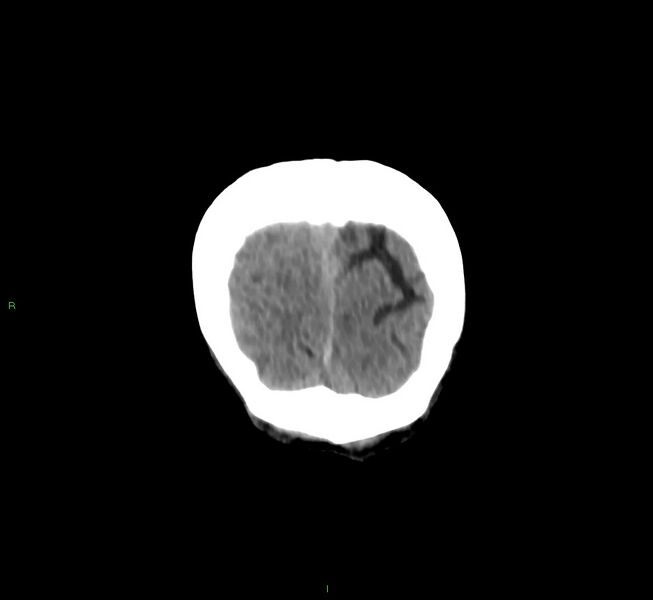 File:Cerebral amyloid angiopathy-associated lobar intracerebral hemorrhage (Radiopaedia 58758-65980 Coronal non-contrast 8).jpg