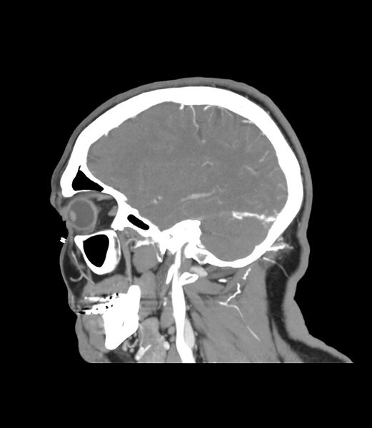 File:Cerebral dural venous sinus thrombosis (Radiopaedia 86514-102576 C 44).jpg