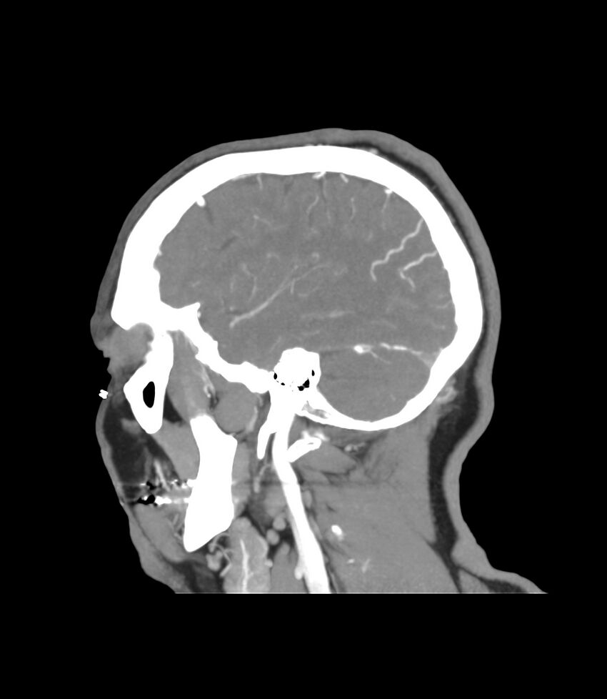 Cerebral dural venous sinus thrombosis (Radiopaedia 86514-102576 C 9).jpg