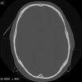 Cerebral hemorrhagic contusion with subdural and subarachnoid hemorrhage (Radiopaedia 10680-11146 Axial bone window 16).jpg
