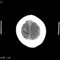 Cerebral hemorrhagic contusion with subdural and subarachnoid hemorrhage (Radiopaedia 10680-19197 Axial non-contrast 23).jpg
