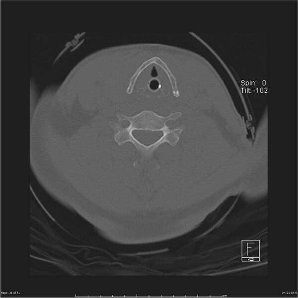 File:Cerebral hemorrhagic contusions and cervical spine fractures (Radiopaedia 32865-33841 C 21).jpg