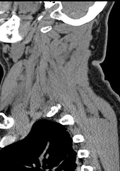 File:Cerebral hemorrhagic contusions and cervical spine fractures (Radiopaedia 32865-33841 G 85).jpg