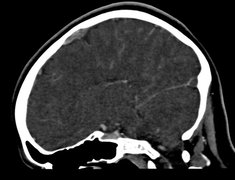 File:Cerebral venous sinus thrombosis (Radiopaedia 59224-66646 Sagittal C+ delayed 33).jpg