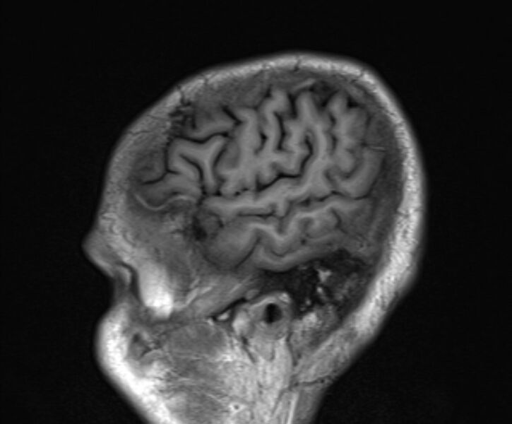 File:Cerebral venous thrombosis (Radiopaedia 71207-81504 Sagittal T1 23).jpg